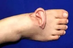 پیوند گوش این زن به پاهایش ـ جزئیات ماجرا