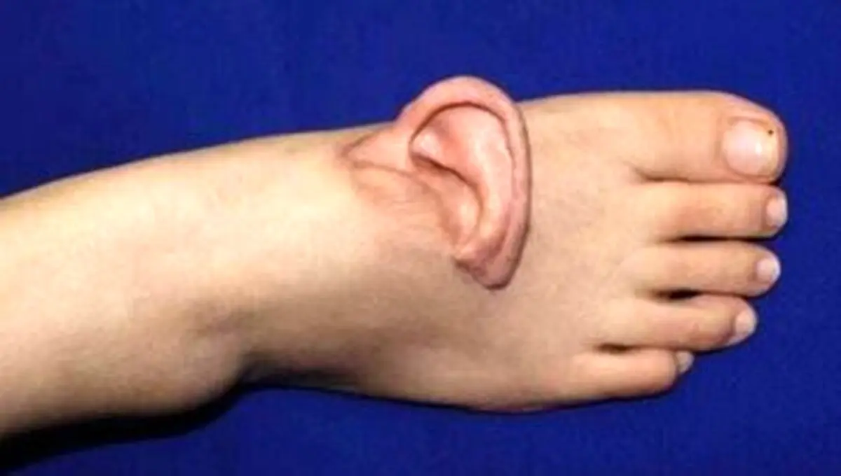 پیوند گوش این زن به پاهایش ـ جزئیات ماجرا