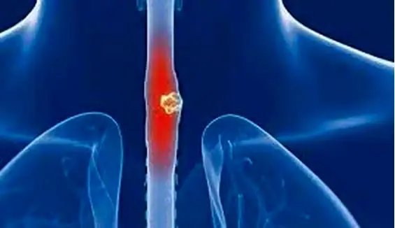 علائم پنهان سرطان مری