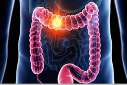 این علائم گوارشی را ساده نگیرید