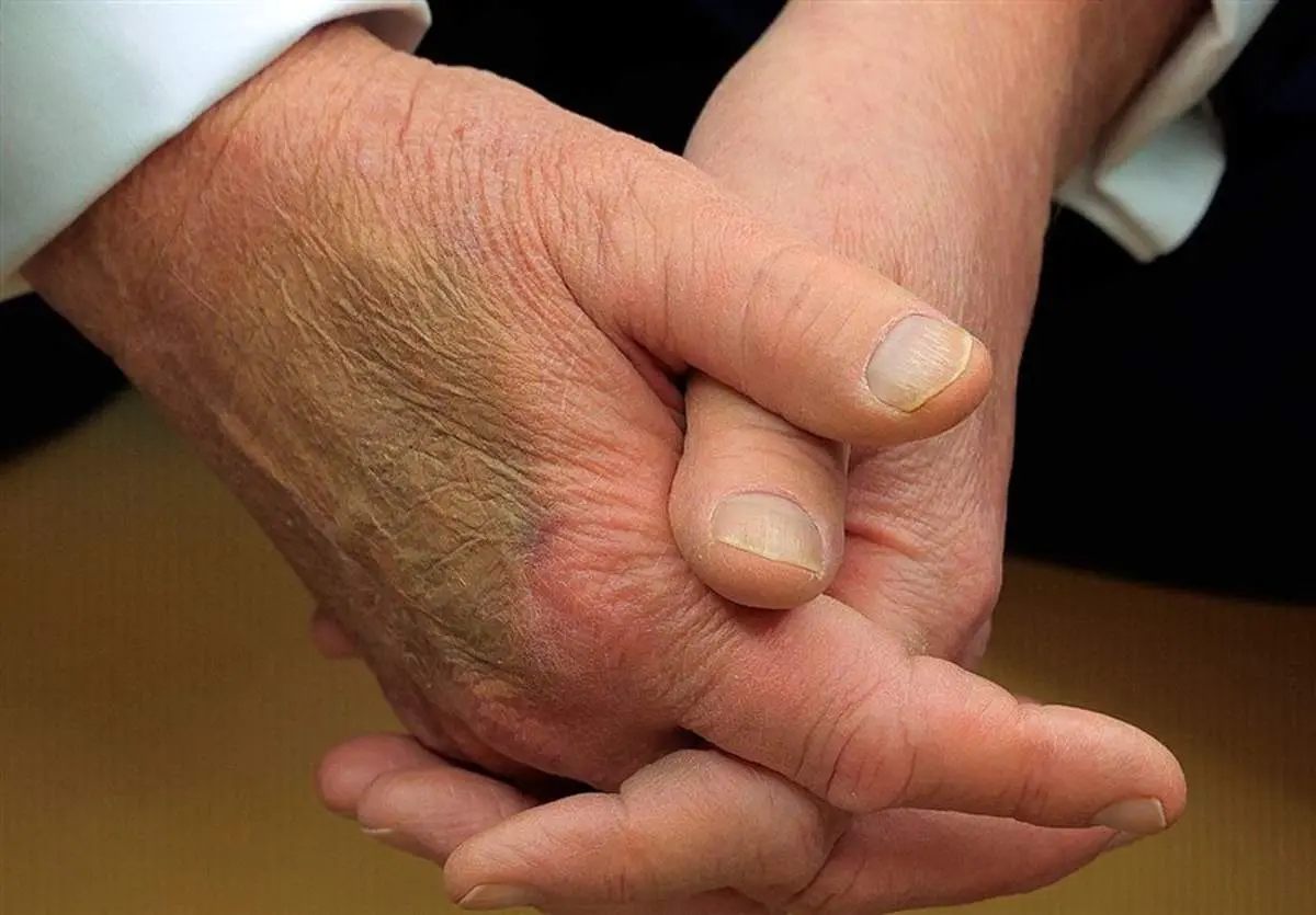 کبودی مزمن ترامپ: آیا دست راست رئیس جمهور دروغ می‌گوید؟